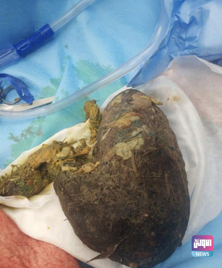 رفع كتلة كبيرة من الشعر من معدة فتاة بالنجف (صورة) 4 74B58308 7195 4715 8243 BCBBBE08E2D2