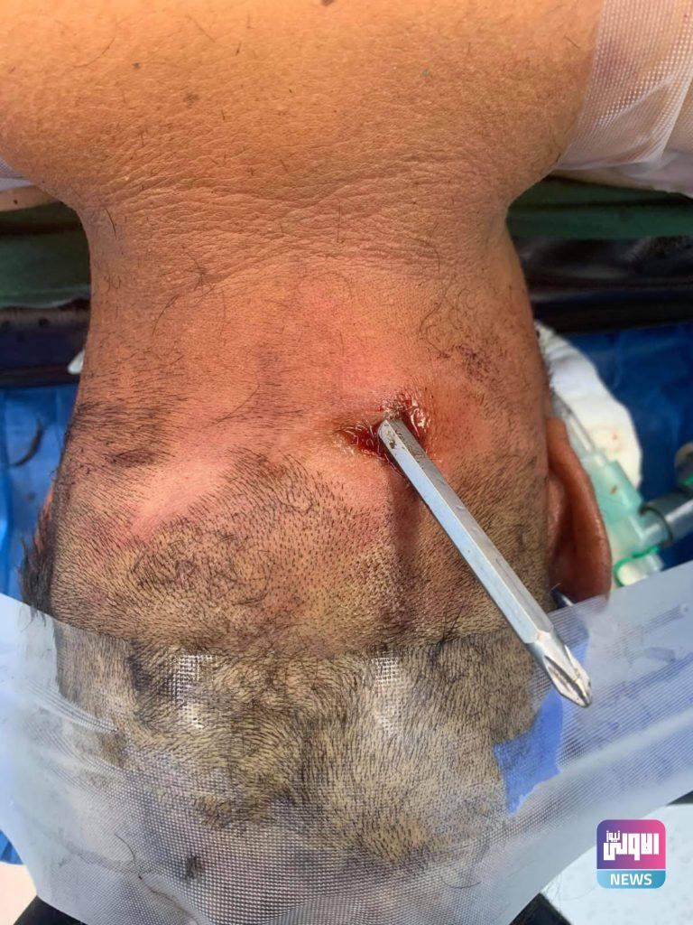 انقاذ رجل أصيب بمفك براغي "درنفيس" بالفقرات العنقية ونفذ للحبل الشوكي 20 72035D9A C097 4839 A9BB B83C60FF9CD8