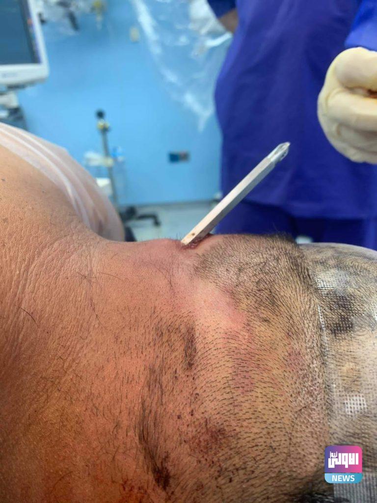 انقاذ رجل أصيب بمفك براغي "درنفيس" بالفقرات العنقية ونفذ للحبل الشوكي 19 A1C2BE79 4105 495F 86FB 1751C9AFC83C